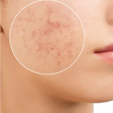 Esteetiline laserlihvimine 