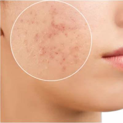 Esteetiline laserlihvimine 