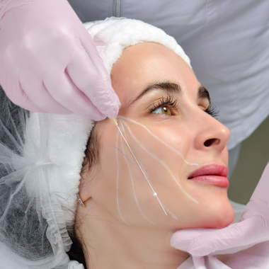 Lifting niitidega APTOS (komplekt)