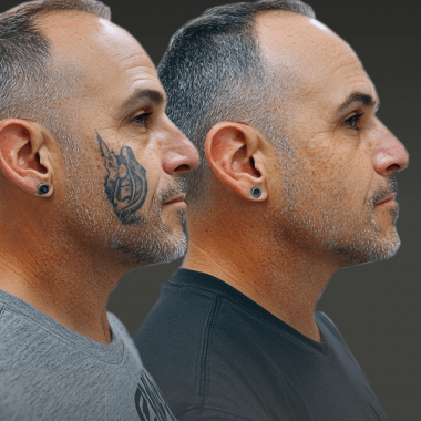 Tätoveeringute eemaldamine Q SWITCH